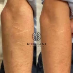 B9E53E13-5CC1-4ECD-8F34-728E618B2328_1_105_c self harm scar before and after