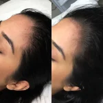 BA52DACC-0CDC-4CB1-A1DE-92C22C27D794 Hair Loss Treatment