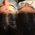CD54353C-F5A3-4AC9-9039-413B0DAFF4F7 Hair Loss Treatment
