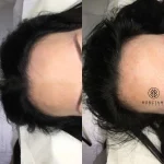 CE89160B-A092-48DB-B365-E92215FB8FFC Hair Loss Treatment