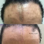 D29DBFCF-0349-4563-9B29-EC4E46C7D2E1 (1) Facial scar pigmentation before and after
