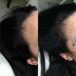 D4226168-0447-4724-91A9-49B5274BEFC7 Hair Loss Treatment