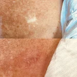 D474D4BC-6DF8-4742-AD6B-E903FE1DFD66 scar camouflage mole before and after