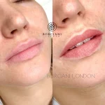 DA5AE841-DE08-4DFA-B266-E64DE3F7EA1B Lip Blush Treatment Before and after