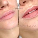 DA5AE841-DE08-4DFA-B266-E64DE3F7EA1B-2-e1614187457498 Lip Blush Treatment Before and after