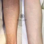 F0CFEDAB-7027-459B-9EEC-F62A7FB31B5A Self harm scar before and after