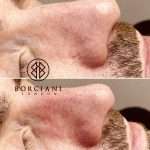 F7E81CA5-2574-4E8D-A01A-930EAB60E9D2_1_105_c Thread vein removal