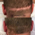FF126827-4AD9-4D5E-B3EE-C887EDED5902 Scar Camouflage Hair Restoration