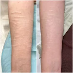 HI6n5 self harm scar before and after