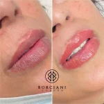 IMG_0118-2 Lip Blush Treatment Before and after