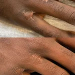 IMG_0125 scar camouflage before and after