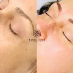 IMG_0252-e1562163332633-400x284 Skin Tightening and pigmentation