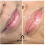 IMG_0480-2 Lip Neutralisation Treatment