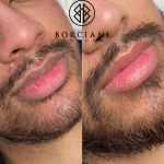 IMG_0882 Lip Neutralisation Treatment