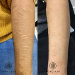 IMG_2677 self harm scar before and after