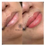 IMG_2828 (1) Lip Neutralisation Treatment