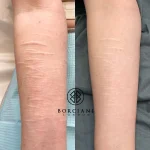 IMG_3636 Self harm scar before and after