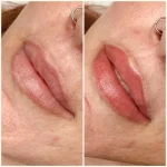 IMG_6183-1 Lip Blush Treatment Before and after