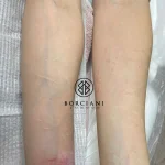 IMG_7392 self harm scar before and after CO2 and camouflage