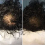 IMG_8240 Hair Loss Treatment