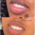 Untitled-3 Lip Neutralisation Treatment