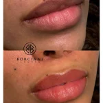Untitled-6 Lip Neutralisation Treatment