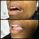 Vitiligo-Lip vitiligo before and after