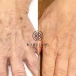 age-spots-400x284 Hand Rejuvenation
