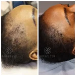 female-scalp Hair Loss Treatment