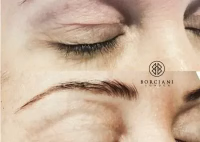 plasma-lift-400x284 Plasma Lift treatment before and after