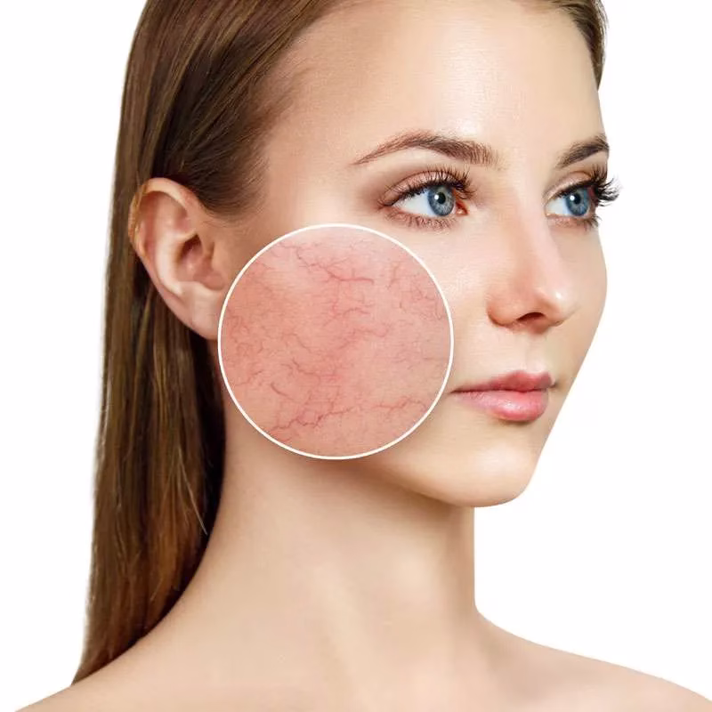 redness-thumb Thread Veins