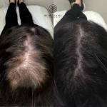 scalp-camou Hair Loss Treatment