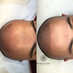 scalp-inner Hair Loss Treatment