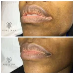 vitiliogo-1 vitiligo before and after