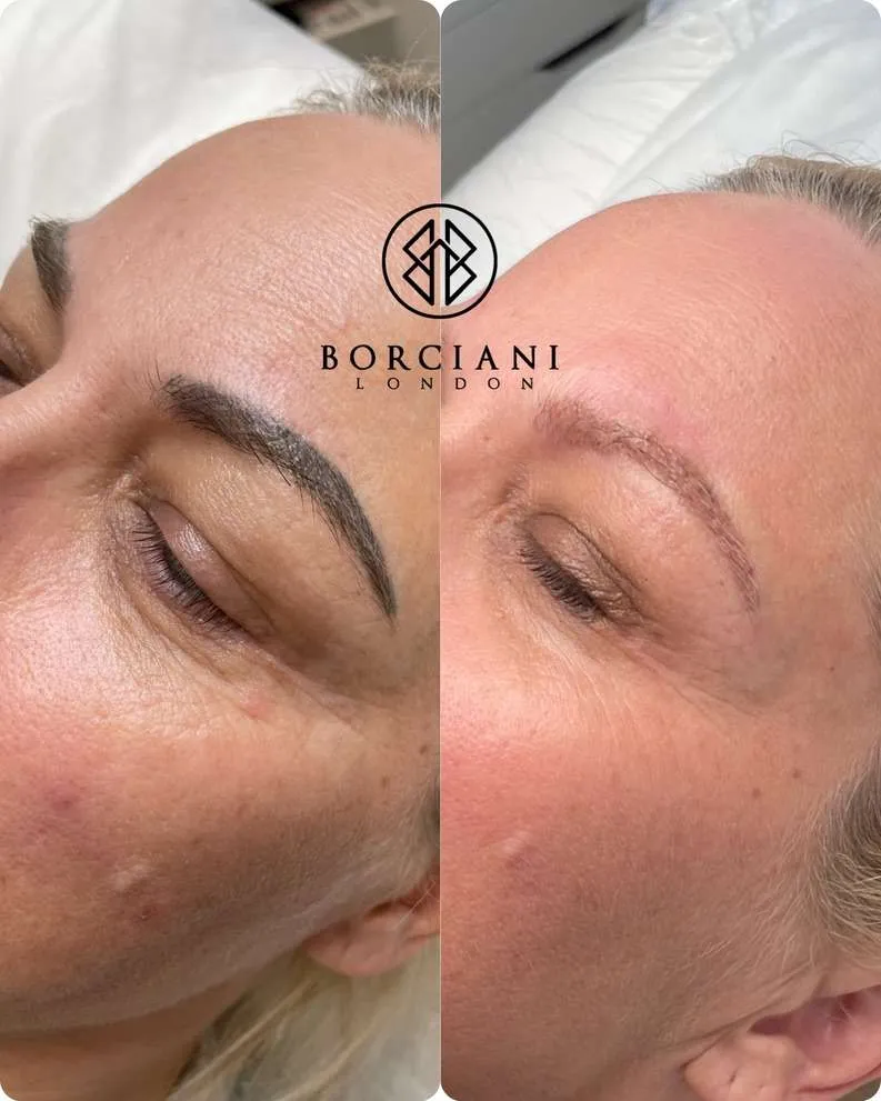 Permanent Makeup Removal in London - What are your options? 3 Laser device used for microblading removal