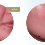 post acne3 post acne3