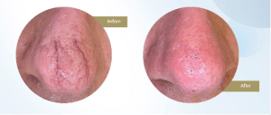 vascular nose vascular nose