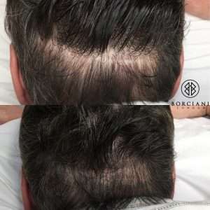 Hair Loss: Why it happens, and how you can fight it 1 E58CB095 6D66 4CAA 9532 174526CDDC11 300x300 1