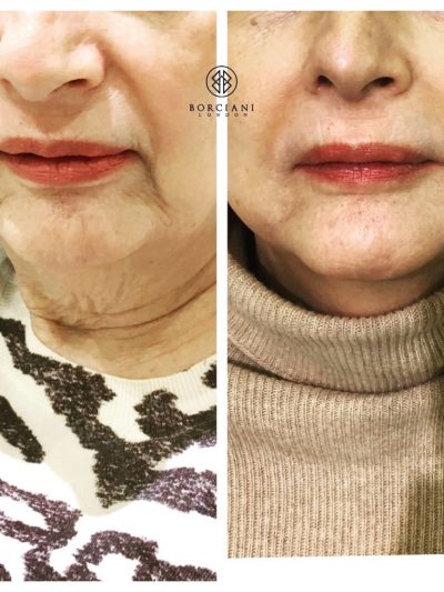 Is Microblading right for me? 2 UNADJUSTEDNONRAW thumb 5b91 400x533 1