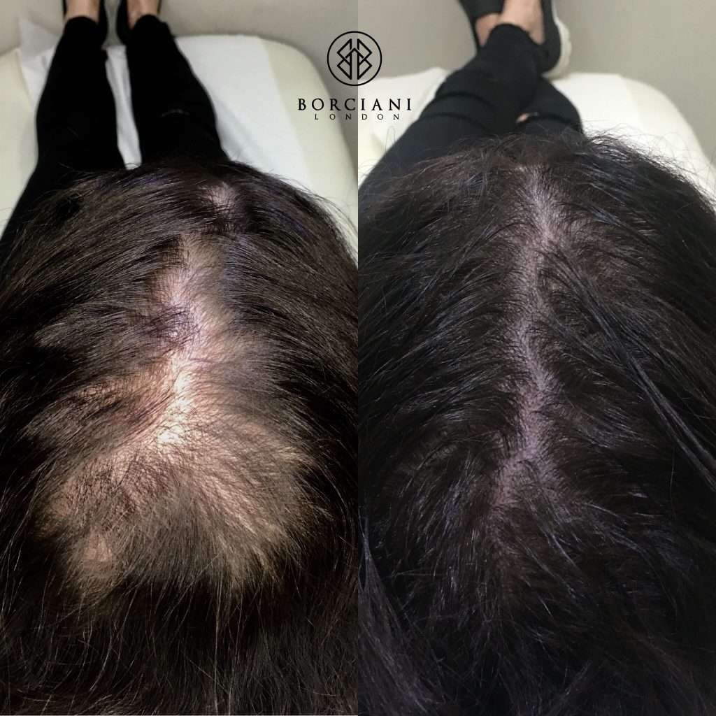 Permanent MakeUp In London 6 Hair Loss