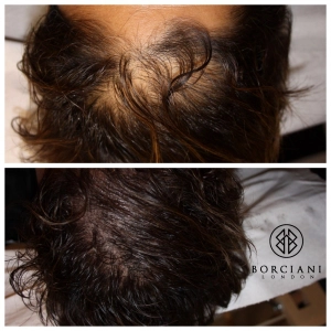Achieve natural looking results with Alopecia treatment 1 Front scalp 300x300 1