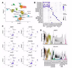 UMAP plots and expression profiles from the publication illustrating co-expression of AEBP1 and collagen genes in cancer-associated fibroblast populations in pancreatic cancer.