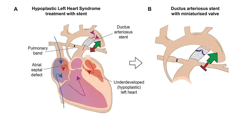 Diagram illustrating hypoplastic left heart syndrome and the placement of a miniaturized heart valve inside a ductus arteriosus stent to regulate blood flow and reduce backflow in neonatal circulation.