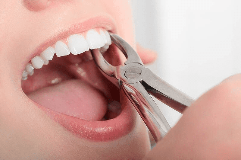 Tooth Extraction Cost: What Factors Affect the Price?