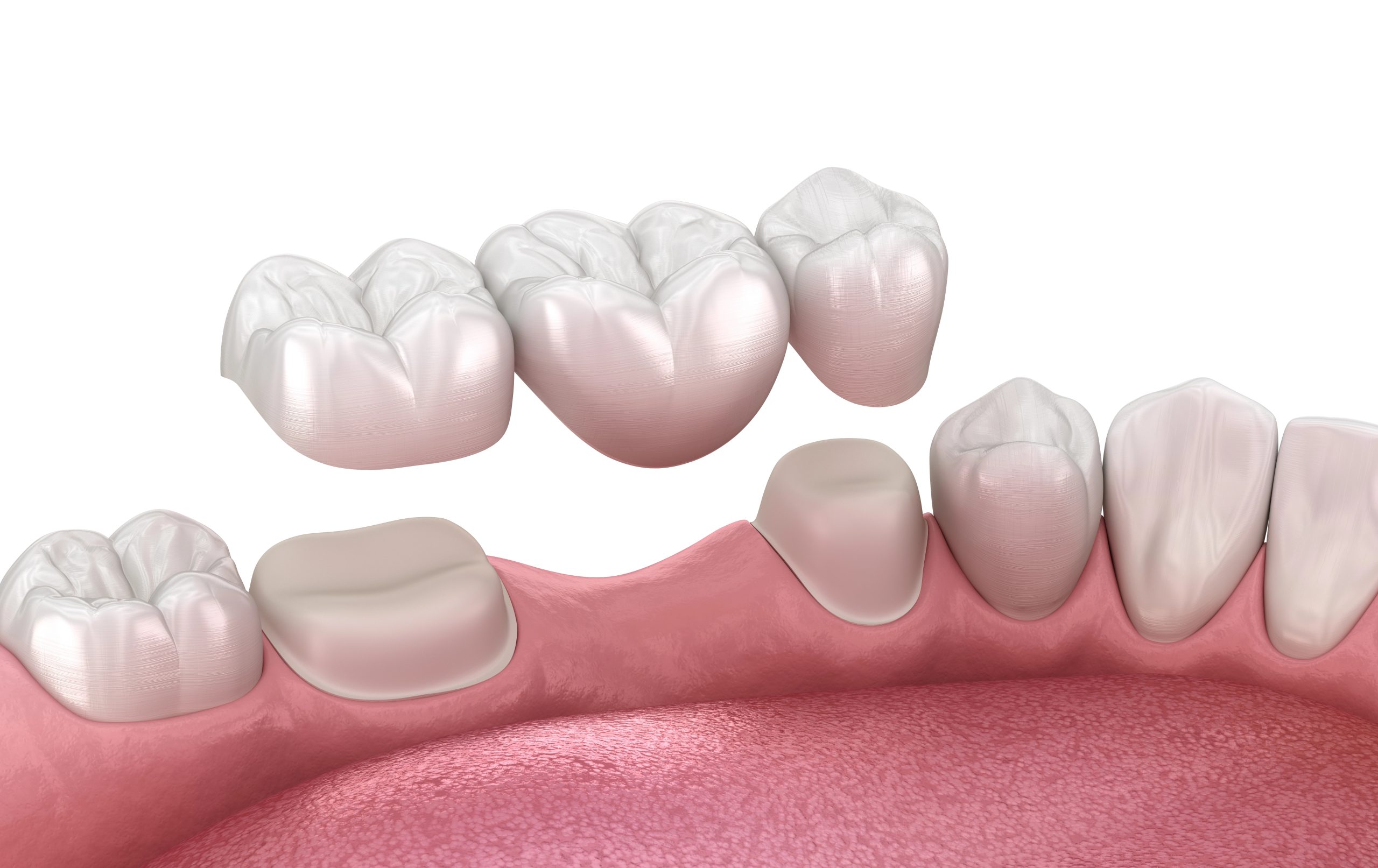 Dentures Without Implants: Traditional Options That Work