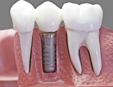 Dentures vs Bridges: Which Tooth Replacement Is Right for You?