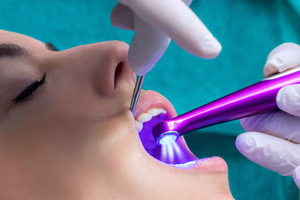 Affordable Dental Sealants: Prevent Cavities Without High Costs