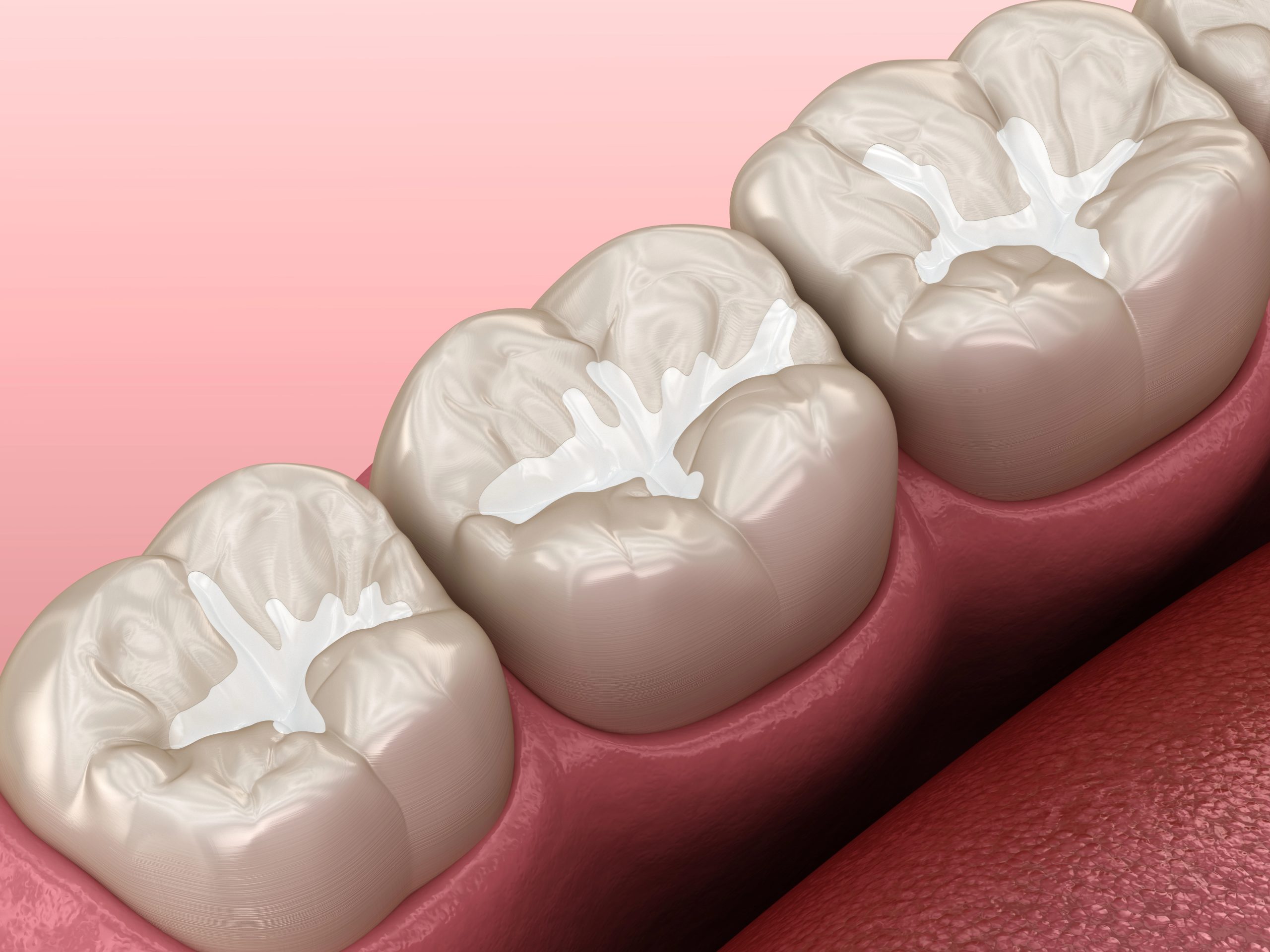 Dental Sealants Without Fluoride: A Natural Approach to Prevention