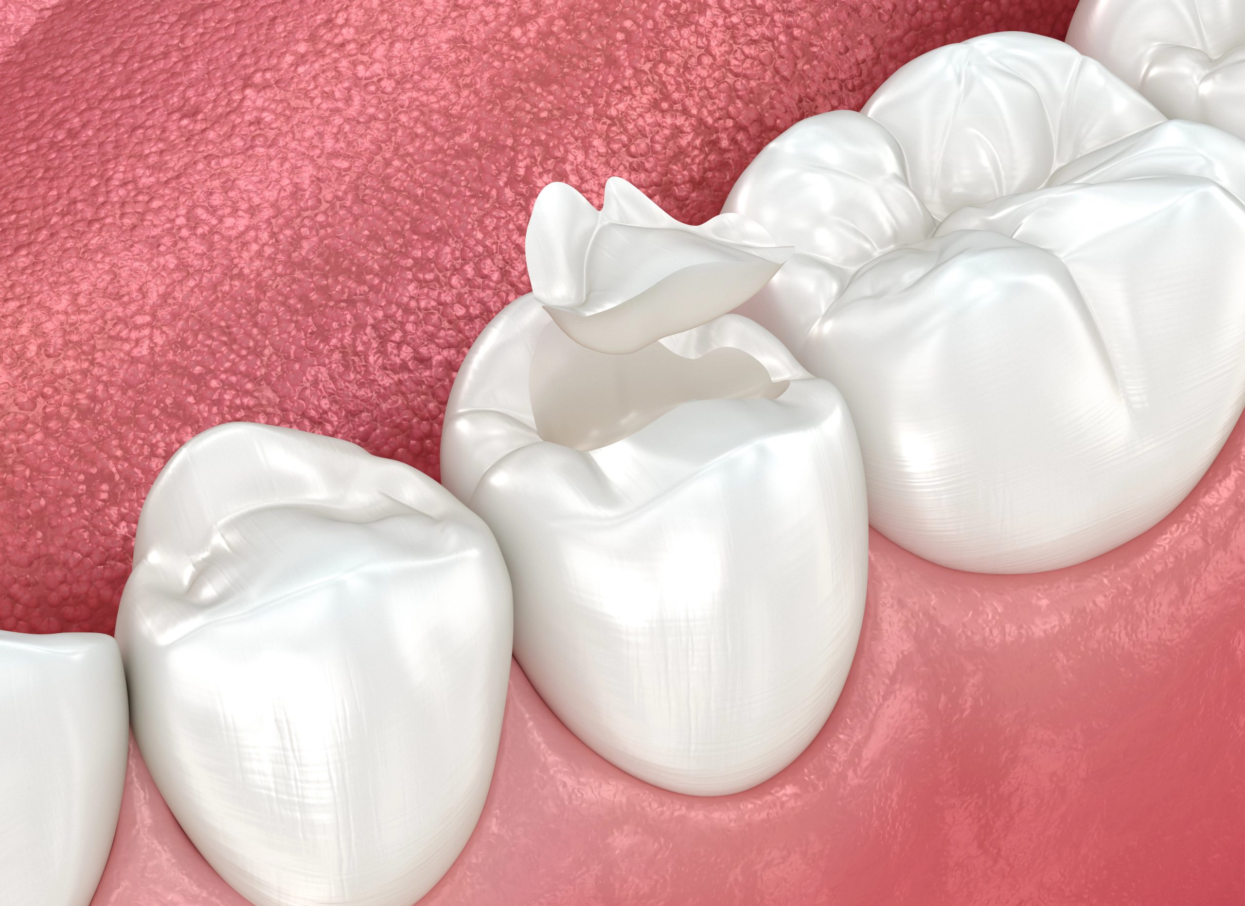 Dental Sealants vs Fillings: Know the Difference in Protective Care