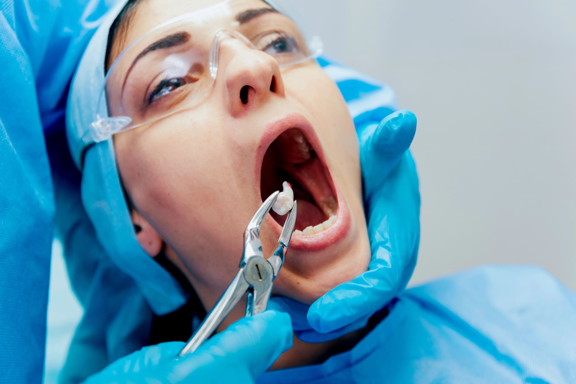 Wisdom Teeth Removal Cost With Insurance Understanding Coverage and Out-of-Pocket Expenses